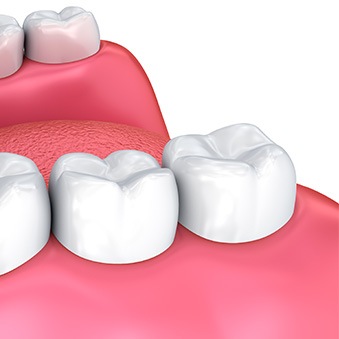 illustration of Dental crowns