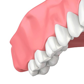 illustration of fillings