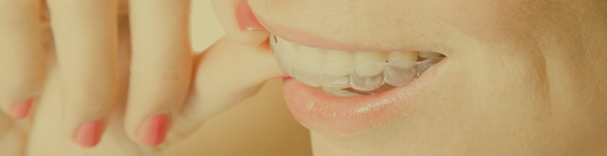 Invisalign