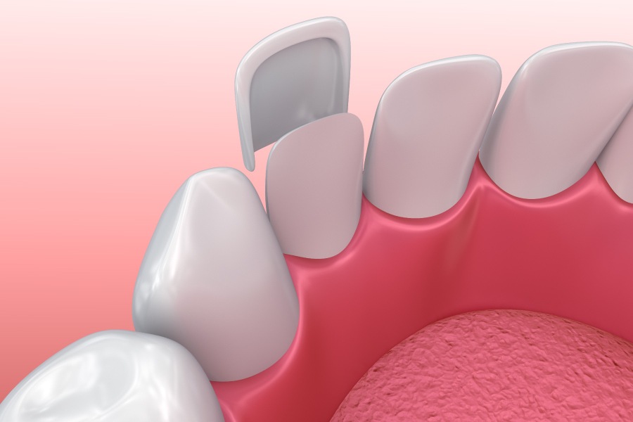 A porcelain veneer bonding to the front of a tooth to improve its appearance