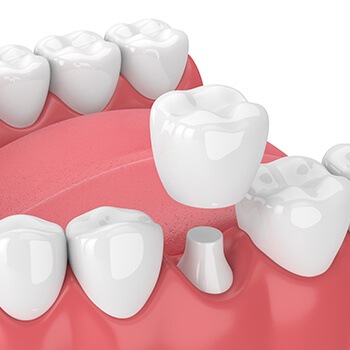 illustration of a dental crown