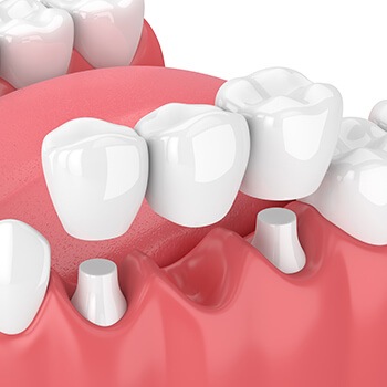 illustration of a dental bridge