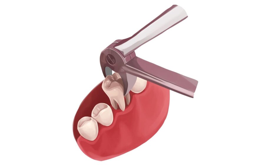 Illustration of a special dental tool performing a tooth extraction