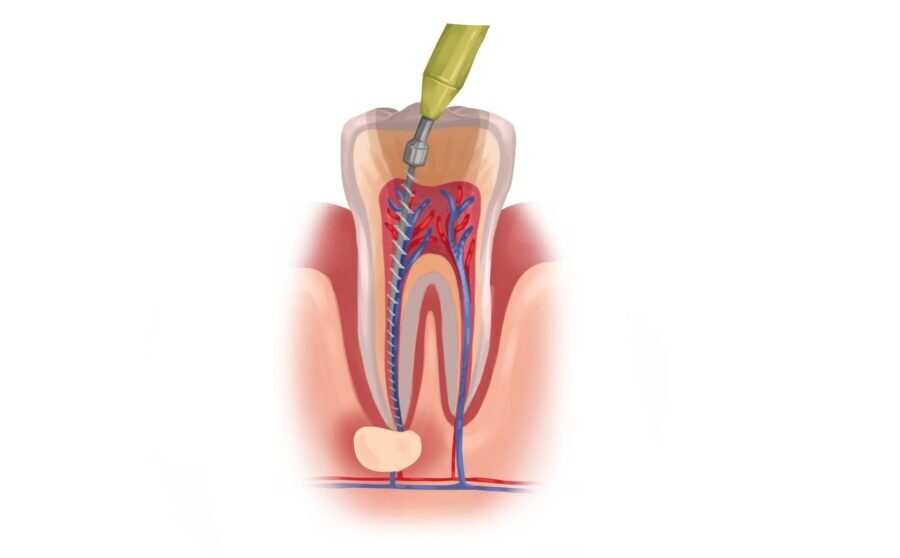 Illustration of a tooth undergoing root canal therapy