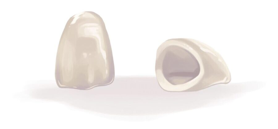 Illustration of dental crowns to reinforce a tooth