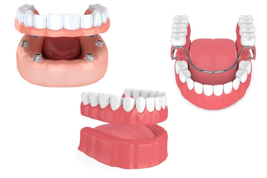 Illustration of 3 different configurations of dentures to replace missing teeth