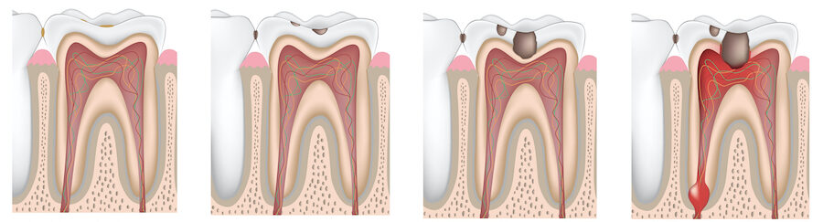 Illustration of a tooth progressively affected by decay