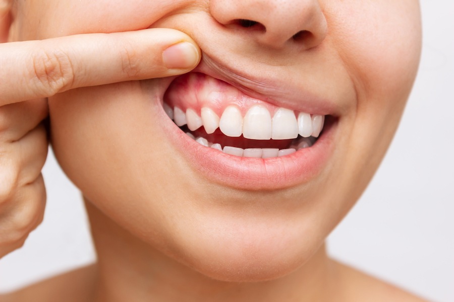 Closeup of a woman pulling back her upper lip to show healthy gums