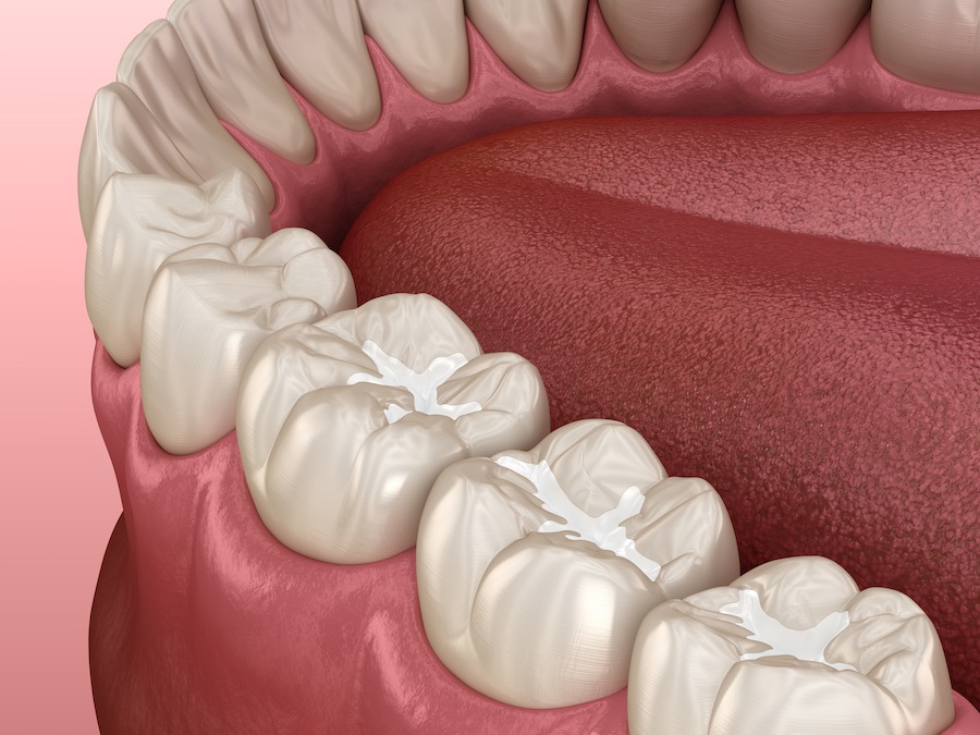 Medically accurate 3D illustration of dental sealants