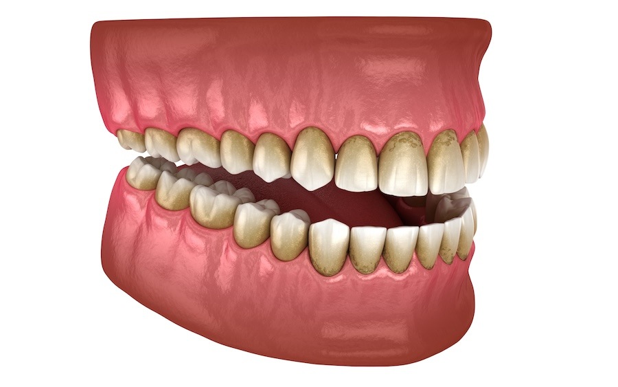 periodontal disease, gum disease, oral hygiene, dental check-ups, gum inflammation, bleeding gums, receding gums, bad breath, loose teeth, Fort Smith dentist